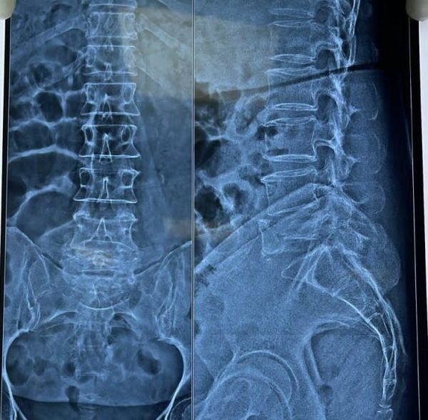 Osteoporotic Spine Fracture After Chemotherapy & Radiotherapy Osteoporotic Spine Fracture After Chemotherapy & Radiotherapy