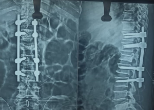 Spine Fracture-1 Spine Fracture-1