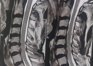 cervical radiculopathy cervical radiculopathy