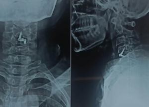 Cervical Disc Prolapse Cervical Disc Prolapse