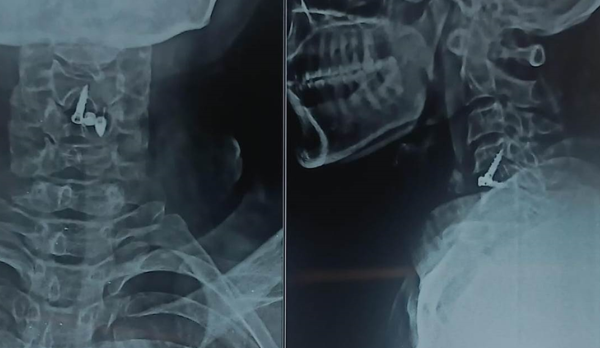 Cervical Disc Prolapse Cervical Disc Prolapse