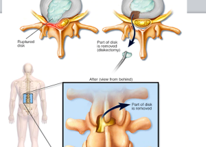 Sciatica or lumbar disc prolapse Sciatica or lumbar disc prolapse