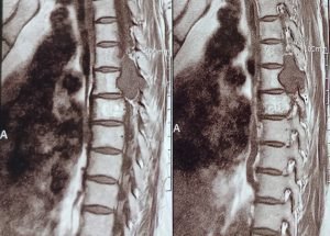 SPINE TUMOUR SPINE TUMOUR