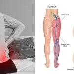 Understanding Slip Disc and Sciatica – Causes, Symptoms & Treatment
