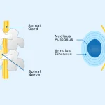 Degenerative Spine – An Age-Related Problem You Should Not Ignore
