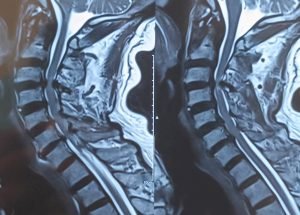 CERVICAL MYELOPATHY CERVICAL MYELOPATHY