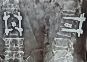Cauda Equina Syndrome Cauda Equina Syndrome