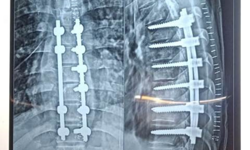 Tuberculosis Spine Tuberculosis Spine